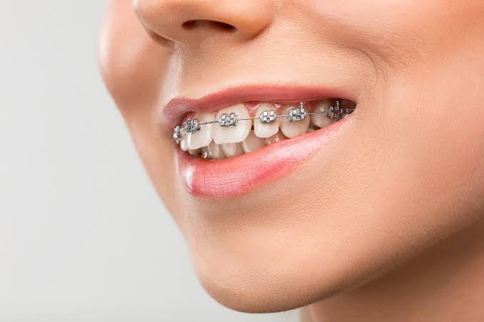 Braces & Aligners