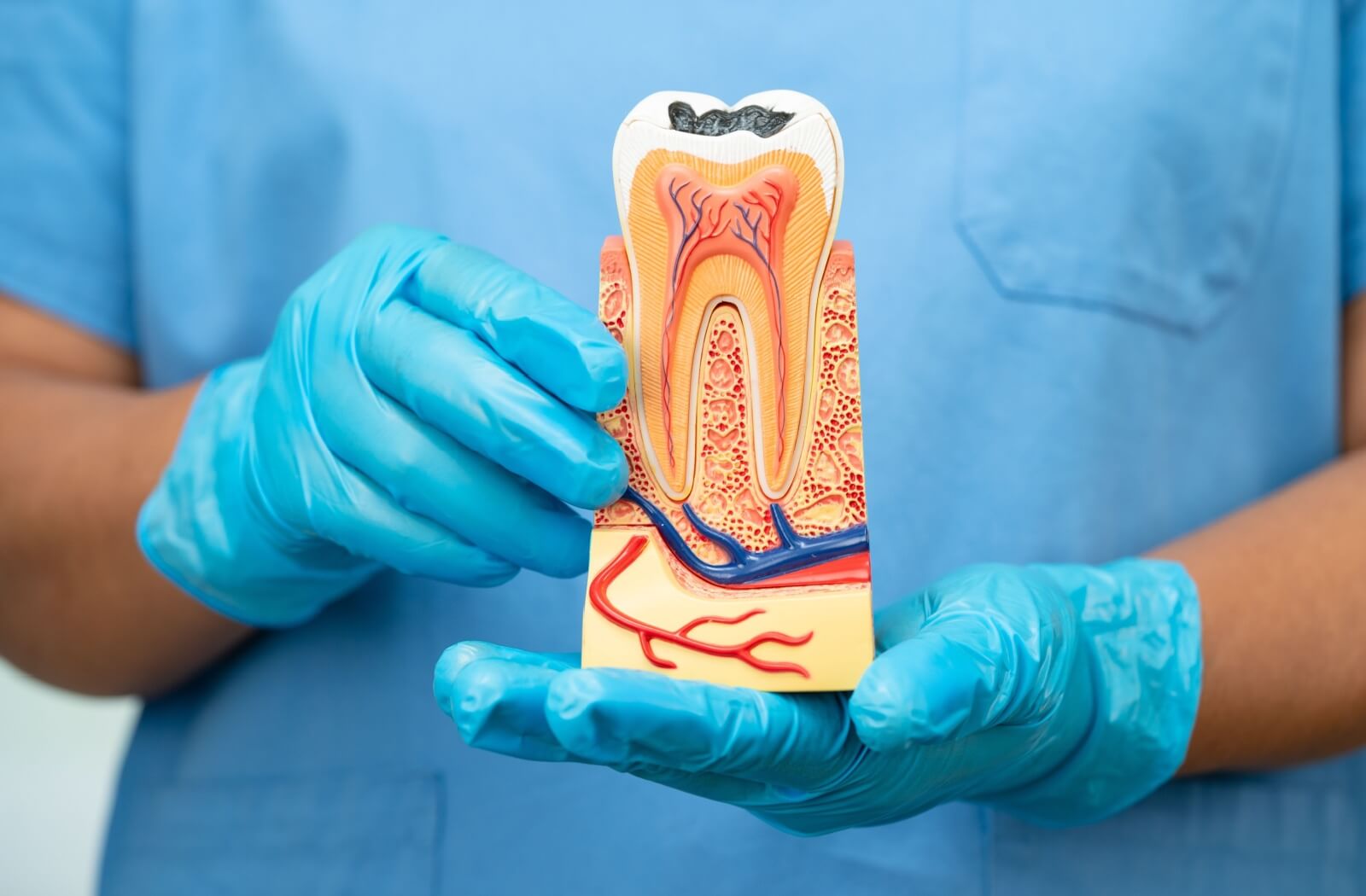 Root Canal Treatment